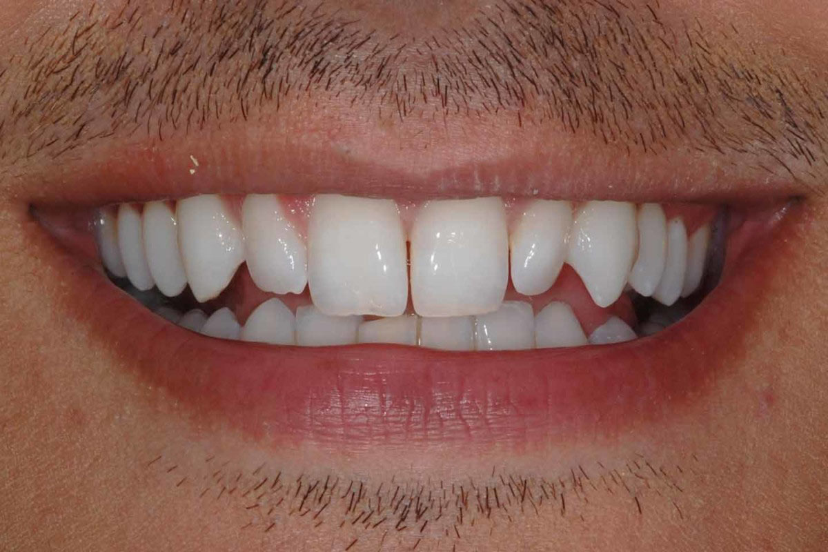 White Clinic Dental Clinic Clínica Dentária Lisboa Casos Complexos Implantes Coroas
