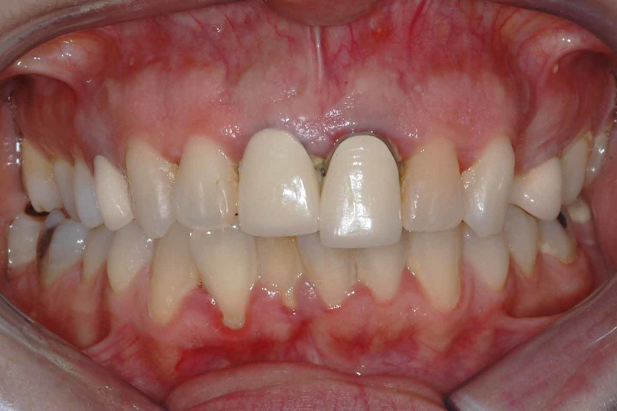 White Clinic Dental Clinic Clínica Dentária Lisboa Casos Complexos Implantes Coroas