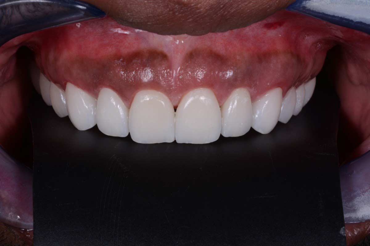 white-clinic-servicos-7 White Clinic serviços Implantes Dentários Dental Implants